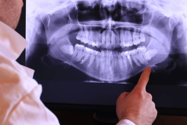 Best Emergency Wisdom Tooth Extraction in Stokesdale, NC